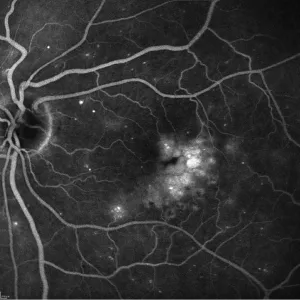 Oedéme maculaire Diabétique (OMD) en Angiographie à la Fluorescéine DIABETE OMC