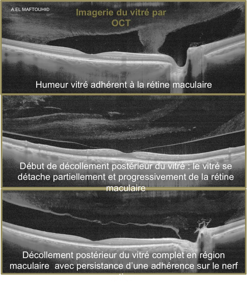 VITRE