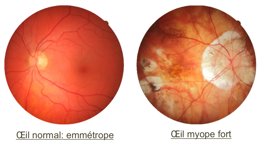 oeil myope fort