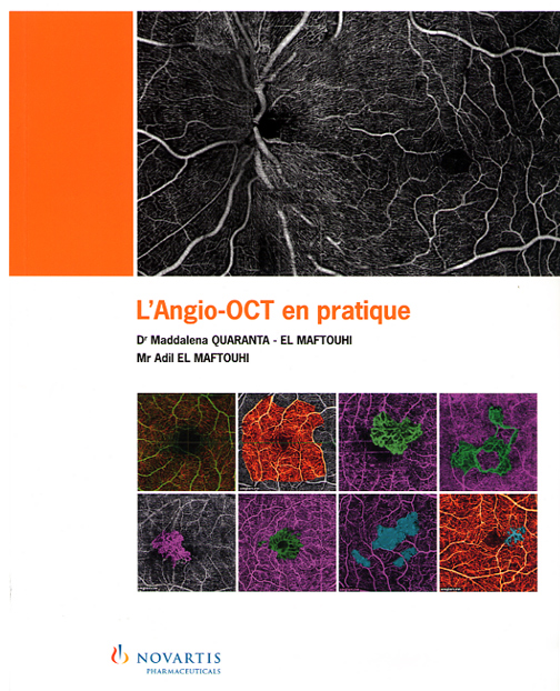 L'angio-OCT en pratique 🇫🇷