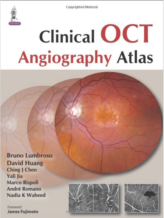 Inner nuclear layer cystic degeneration, in macular area of glaucomatous patients, on 'en face' and B-scan OCT scanning